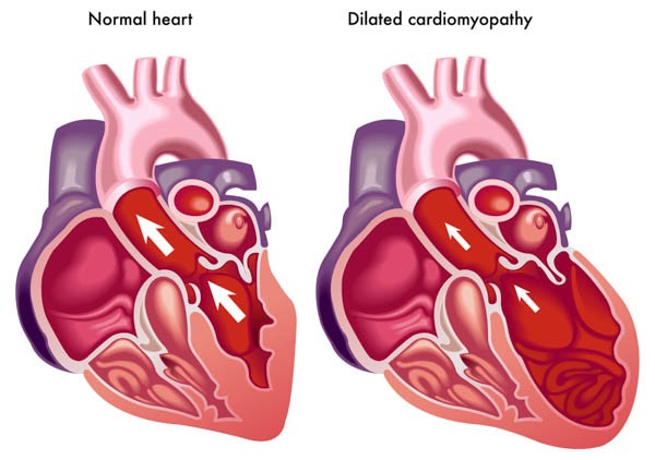 Bệnh Hypertrophic cardiomyopathy (HCM)